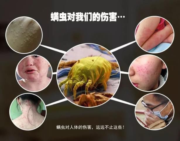 90的人都在陪螨虫睡觉螨虫最怕3种东西，好好利用，螨虫跑光光