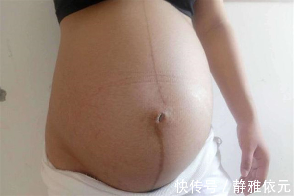 孕妈|怀孕时肚子上的“黑线”代表啥还有孕妈不知道，看完就明白了