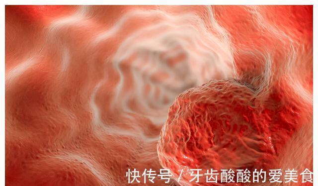 肿瘤|结直肠癌不能手术了?这些药物治疗可以了解一下