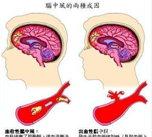 服用|高血压是“中风”主要危险因素,预防中风,需要做好以下3点!