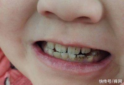 刷牙|3岁儿子满口小黑牙,送去医院检查后,医生的话让妈妈万分羞愧