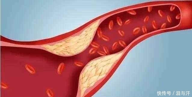 血管|有高血压的人要不要长期服用阿司匹林,要看这三件事做的怎么样