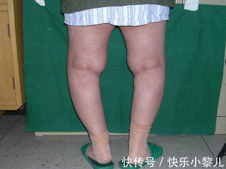 宝宝|别给新生儿穿两种衣服,会影响宝宝腿型发育,长大腿型差会怪你