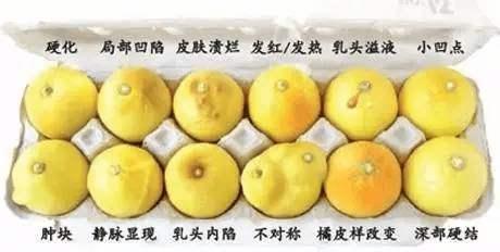 症状|得了乳腺癌,一般哪里会疼医生边辟谣边告诉您如何预防乳腺癌