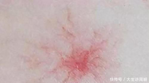 蜘蛛痣|身上突然长出这种小红痣，别大意，可能是某些疾病的预警信号