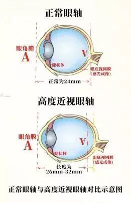 单纯性近视|近视600度以上和600度以下,区别仅仅是几个度数吗?