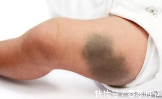 林静|宝宝出生屁股“淤青”,不要以为是天生,可能宝妈孕期做了这些事