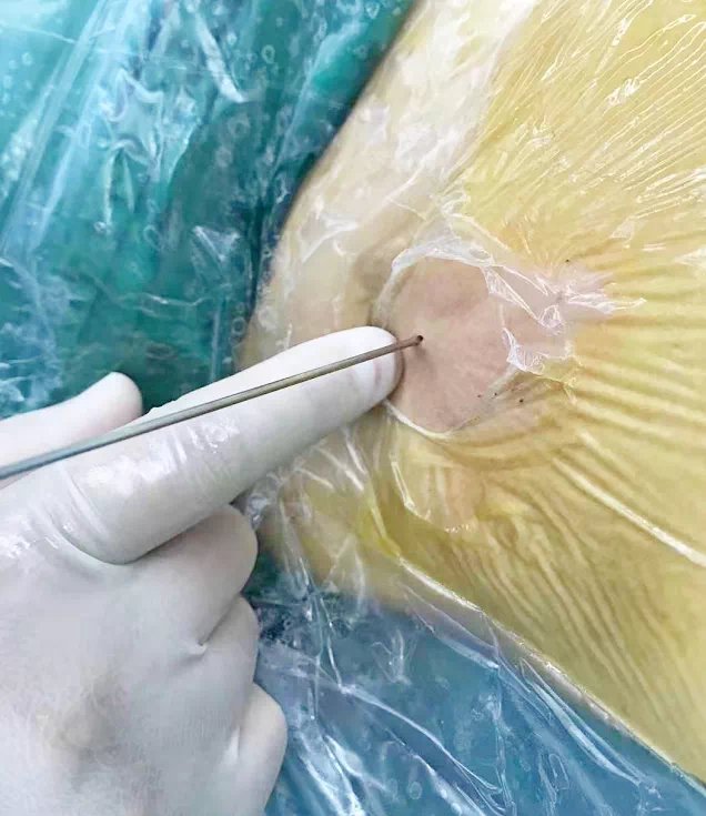 肾结石|微创时代！潍坊市中医院1.4毫米“针孔”通道粉碎肾结石