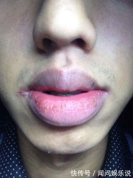 不良习惯|肝不好,嘴先知!无论男女,嘴上有3个“预兆”,肝硬化一触即发