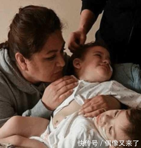 双胞胎姐妹|连体双胞胎姐妹成功分离,不仅没死亡还很健康,只是都少了一条腿