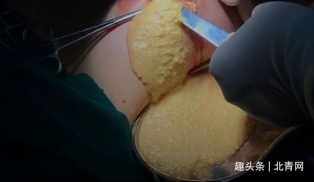 皮下组织|女子胸部取出200ml“鱼卵”！医生提醒未婚未育女性莫轻率尝试