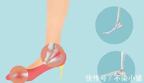 损伤|走路健身反而伤了膝盖，原因是什么运动时，如何做才不伤膝盖