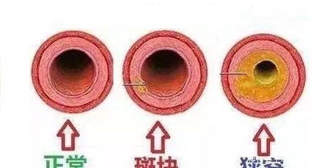 脖子上长了这个东西要当心!医生:多数脑梗都是因它而起!