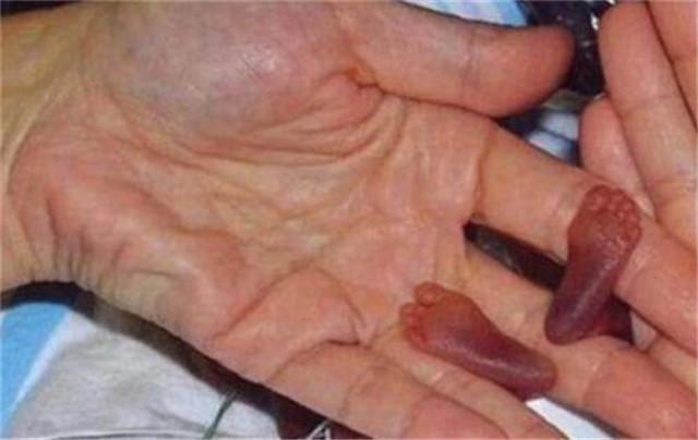 老妇人|现实版“拇指姑娘”！出生时仅25厘米，打破世界纪录，现如今判若两人