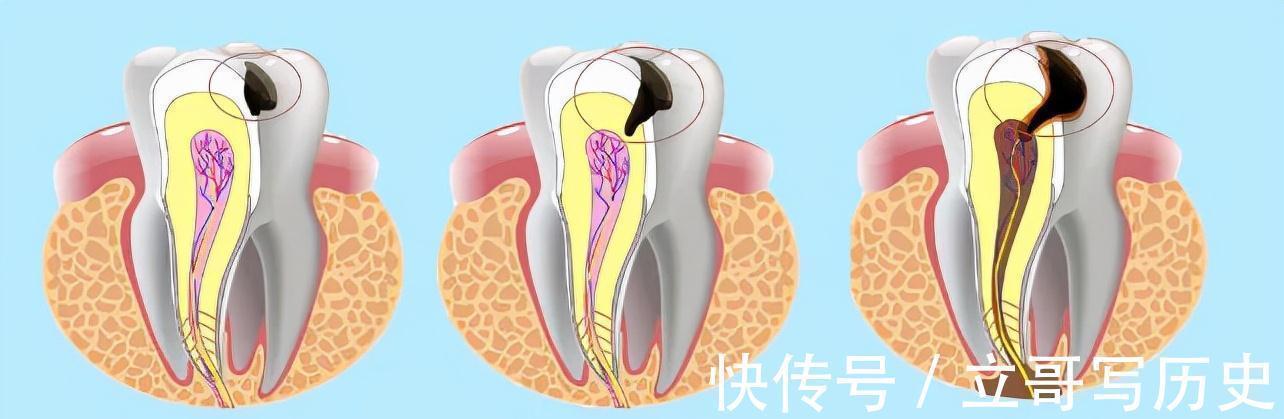 龋齿|5岁女孩满嘴小黑牙,不是糖果惹的祸,而是这种坏习惯造成的