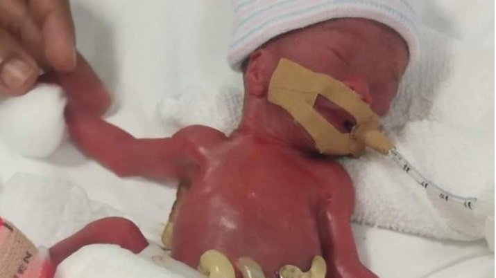 玉萱|出生时仅212克，世界最小婴儿住院13个月后出院了