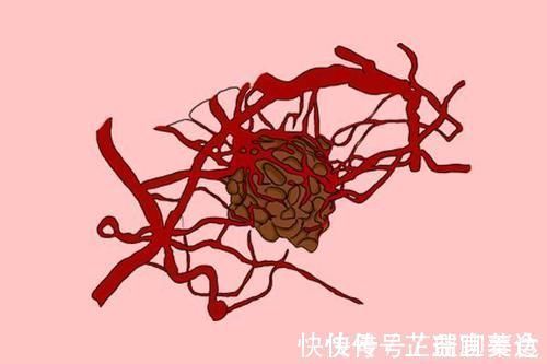 癌细胞|恶性肿瘤是如何进行转移的?医生列出了4个途径,早了解早预防