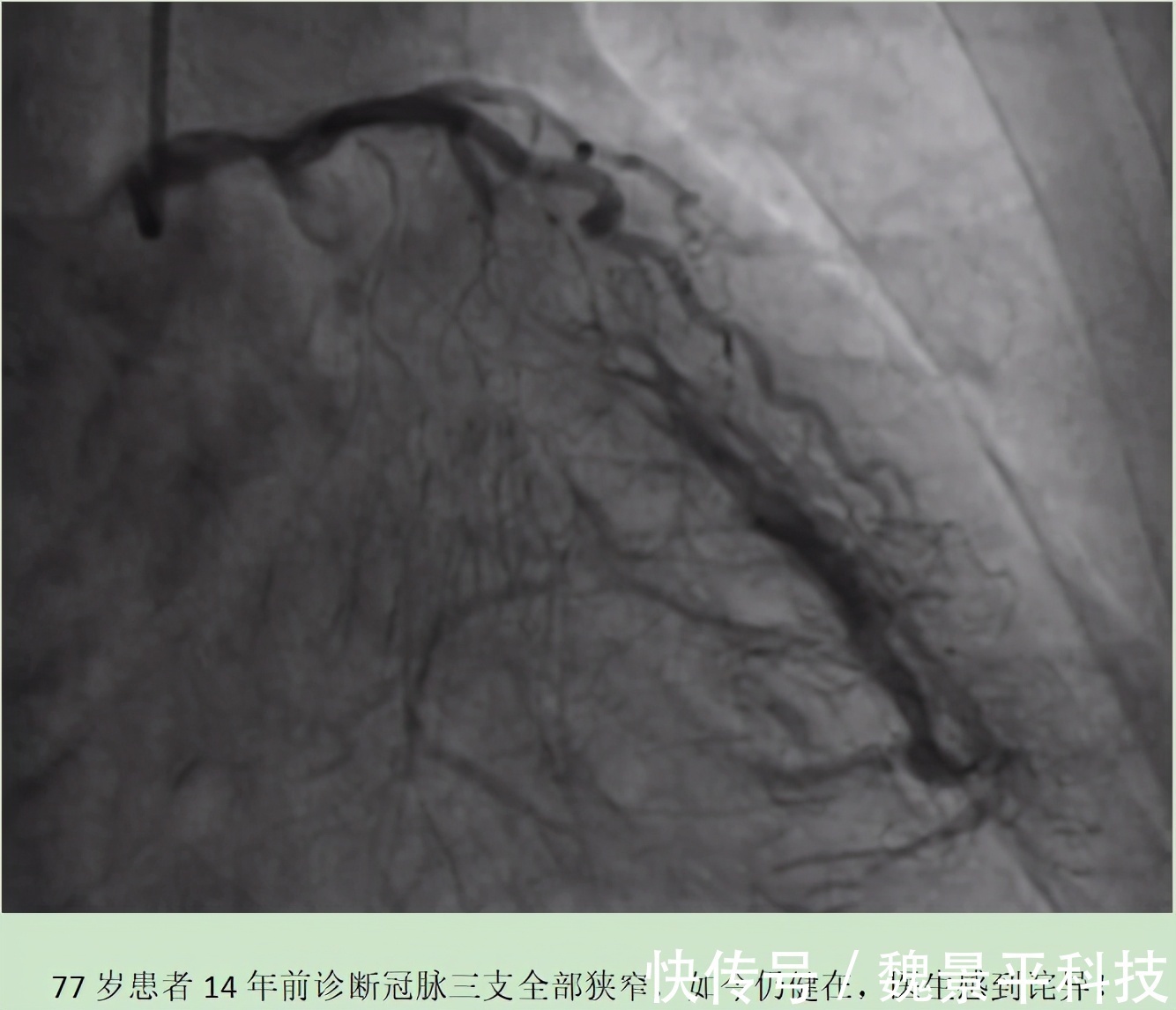 老马|冠心病拒绝支架,14年后仍健在,医生诧异!原来他只做对了两件事