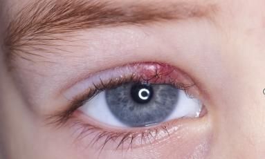 玲玲|孩子长了“针眼”,怎样才能消得快?医生提醒:千万不能用手挤