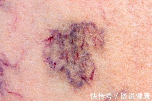 血糖|不想被血栓“缠上”?做好这4点,或能避免血栓找上门