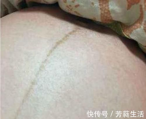 妊娠线|孕妈肚子上的黑线是什么?线在左是男在右是女?原来这么多讲究!