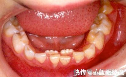 六龄齿|送给孩子正在换牙的父母们,你们一直都做错了什么?