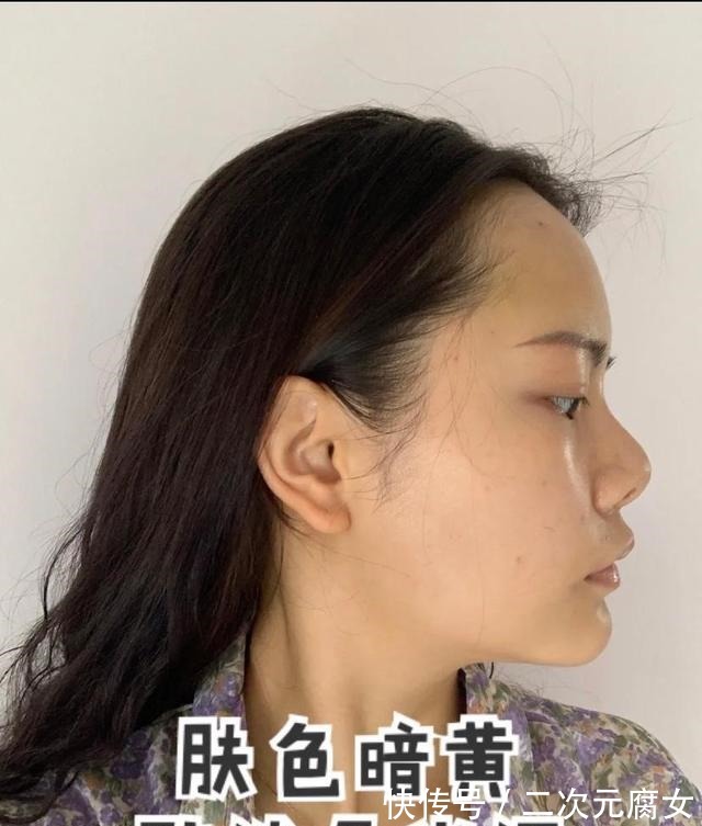 肤色 经常做光子嫩肤的人,皮肤后来怎么样了!
