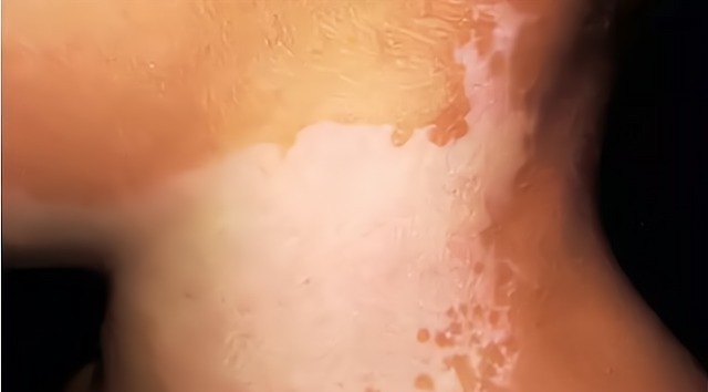 胎记|宝宝的胎记怎么来的?产科医生:孕期这2种行为易长胎记,要避开