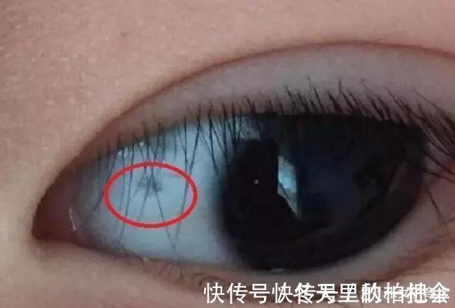 张女子|3岁宝宝眼白出现黑点，怎么回事儿听了医生的答案，终于放心了