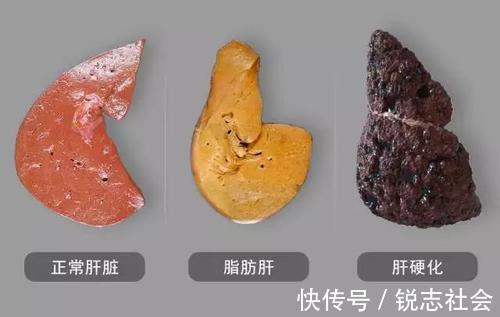 指甲|肝炎加重了伸开双手就知道,3变化及时检查,取冰箱2物养好肝