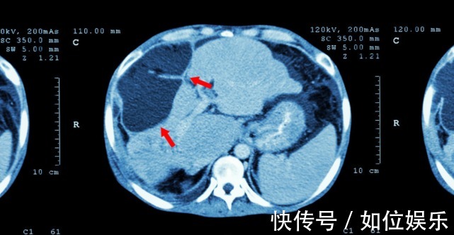 胆红素|男子腹痛查出肝癌,3月后离世,医生1年前有预兆,可他不当回事