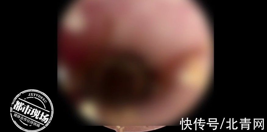 小李|半夜男子剧痛，耳朵里有东西