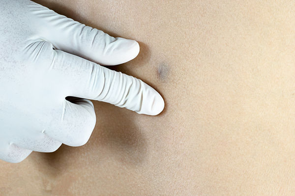 体检|年过50想长寿,要留心身上的4个“小凸起”,离癌症近的人才会有