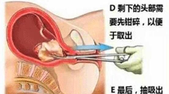 流产|朋友意外怀孕要人工流产,看到这组流产过程图,她哭了