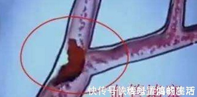 降血压|高血压, 90的140, 还要吃降压药吗 听听专家怎么说！