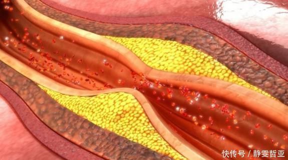 身体出现3种疼痛,多半是血管堵塞的信号,早发现早调理!