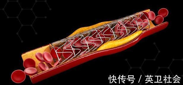 血栓|人体能自动消除血栓!做到5件事,净血液,血栓不“添堵”