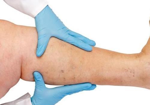 症状|体内有血栓,腿先知!腿部出现这些特征,警惕血管越来越窄