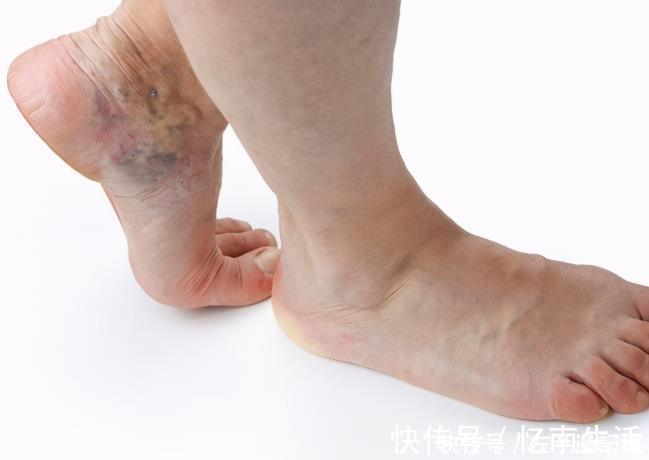 静脉|体内有血栓，脚知道脚上若有4种反应，小心血管随时爆发