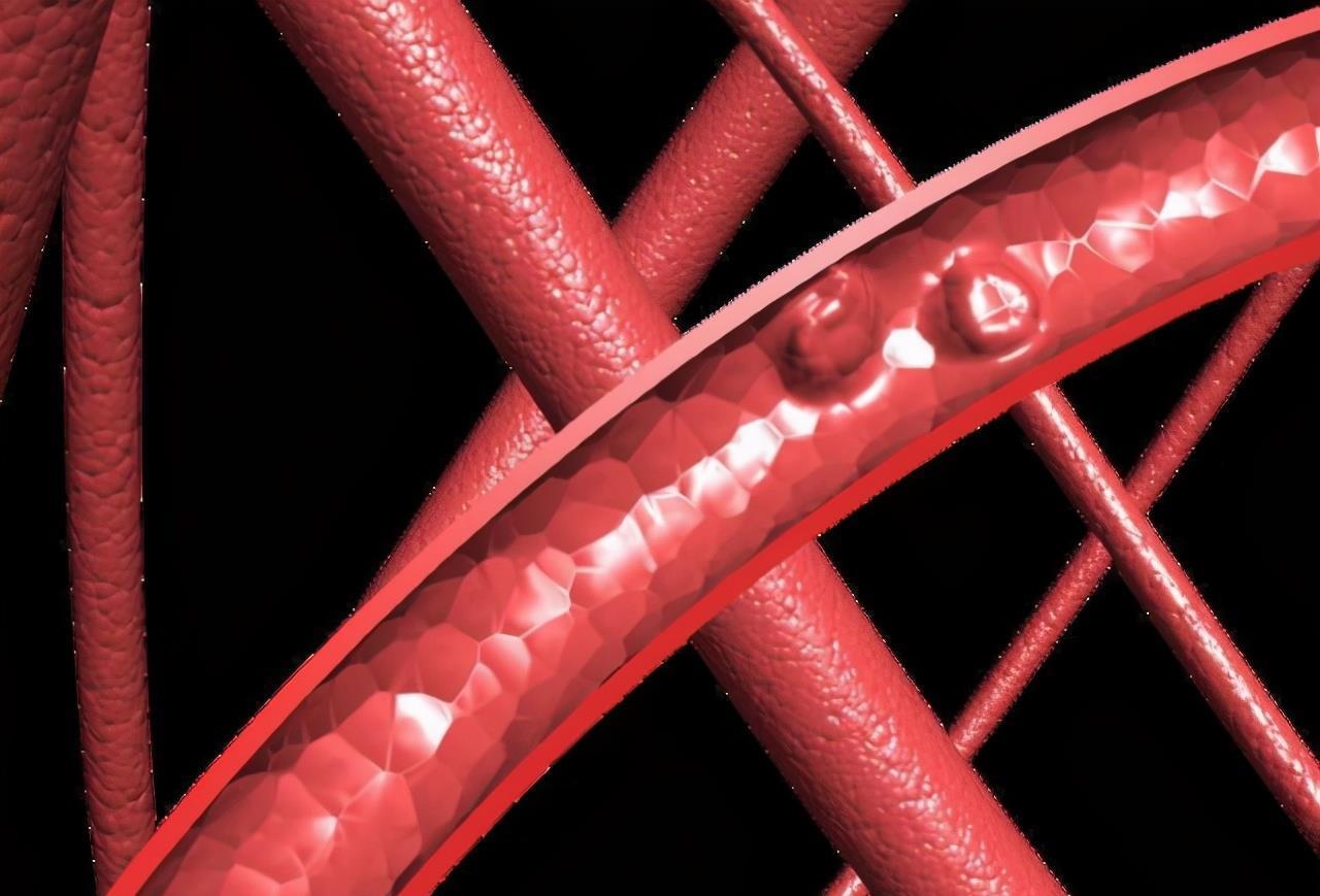 心肌梗死|突发心梗的一桩桩案例告诉我们：隐藏的“第四高”比三高更危险