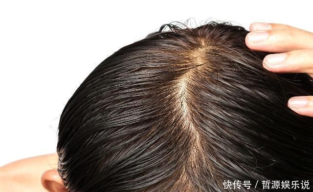 头皮上有白色的东西，很多人都喜欢抠，这些到底是什么东西？