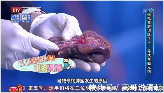 结石|致命肾癌竟是结石惹的祸2大饮食习惯暗藏风险，可惜很多人不知