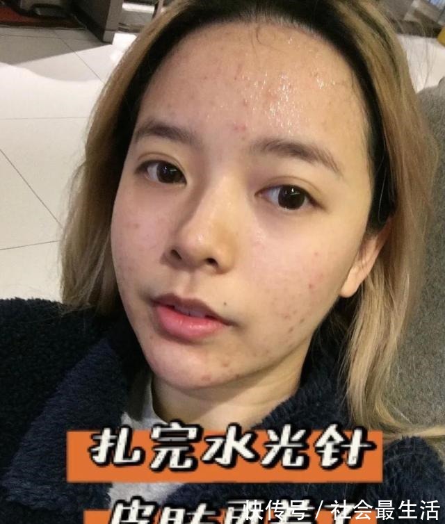 恢复步骤 必看,正确的水光针术后恢复步骤!必看,正确的水光针术后恢复步骤!