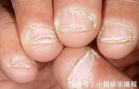 黄甲综合征|身体有问题,指甲告诉你!指甲出现9种变化,恐是疾病来袭
