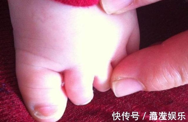 孩子|6岁宝宝双脚“变形”只因常年穿“这种鞋”,父母要重视起来