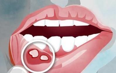 溃疡|一瓶维生素B2,就能防脑溢血防溃疡防癌症,在家可以考虑多备几瓶