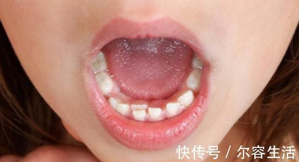 恒牙|越来越多孩子长“双排牙”，与糖果无关，是父母喂养有误区