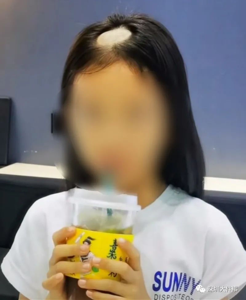患儿|6岁女童突然“秃头”!近期接诊5例,与它有关!专家提醒