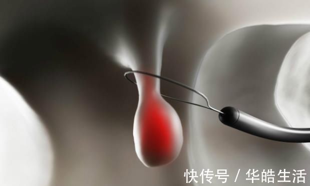 肠镜检查|有三种息肉最好及时切除，拖延太久就会变成恶性肿瘤！你清楚吗？