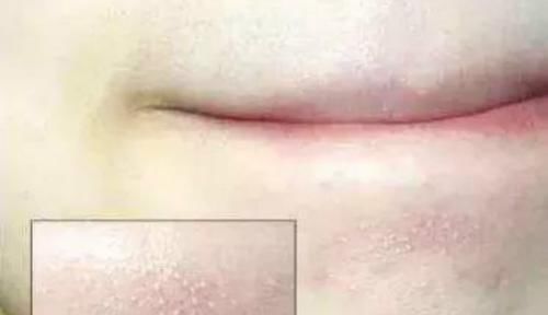为何下巴长了很多小疙瘩？教你2个实用方法，快速去除小疙瘩